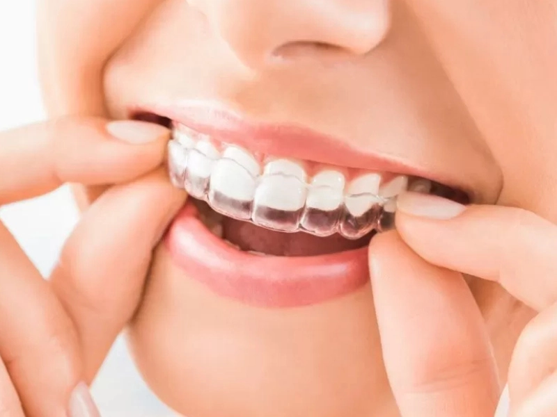 Tratamento com alinhadores transparentes Invisalign em Piracicaba